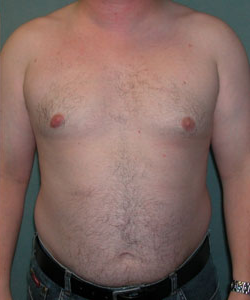 Asymmetric/Unilateral After Photo Asymmetric/Unilateral