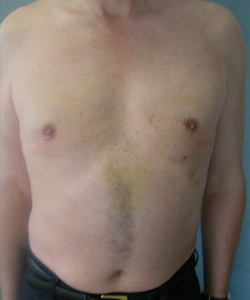 Asymmetric/Unilateral After Photo Asymmetric/Unilateral