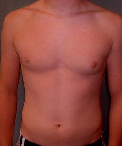 Asymmetric/Unilateral Before Photo Asymmetric/Unilateral