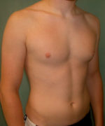 Asymmetric/Unilateral