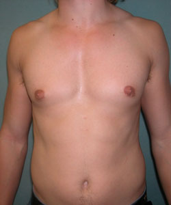 Asymmetric/Unilateral Before Photo Asymmetric/Unilateral