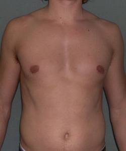 Asymmetric/Unilateral After Photo Asymmetric/Unilateral
