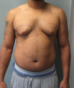 Asymmetric/Unilateral Before Photo Asymmetric/Unilateral