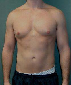 Asymmetric/Unilateral Before Photo Asymmetric/Unilateral