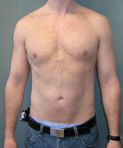 Asymmetric/Unilateral After Photo Asymmetric/Unilateral