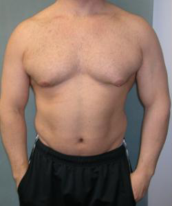 Asymmetric/Unilateral Before Photo Asymmetric/Unilateral