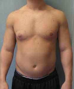Asymmetric/Unilateral Before Photo Asymmetric/Unilateral