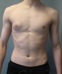 Asymmetric/Unilateral Before Photo Asymmetric/Unilateral
