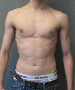 Asymmetric/Unilateral After Photo Asymmetric/Unilateral