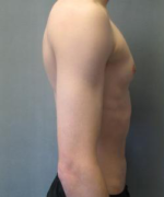 Asymmetric/Unilateral