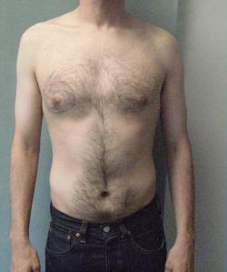 Asymmetric/Unilateral Before Photo Asymmetric/Unilateral