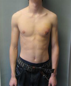 Asymmetric/Unilateral After Photo Asymmetric/Unilateral