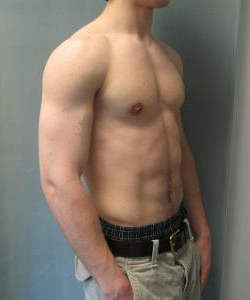 Asymmetric/Unilateral Gynecomastia Surgery