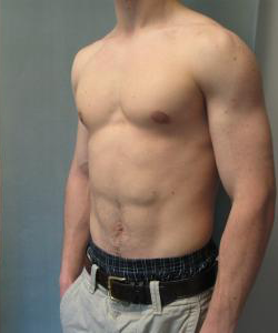Asymmetric/Unilateral Gynecomastia Surgery