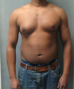 Asymmetric/Unilateral Before Photo Asymmetric/Unilateral