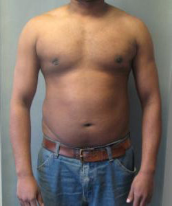 Asymmetric/Unilateral After Photo Asymmetric/Unilateral