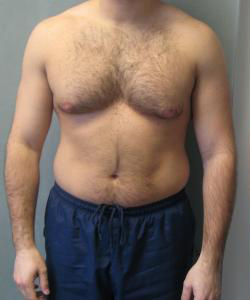 Asymmetric/Unilateral Before Photo Asymmetric/Unilateral