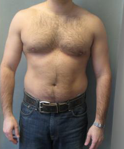 Asymmetric/Unilateral After Photo Asymmetric/Unilateral