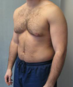 Asymmetric/Unilateral Gynecomastia Surgery