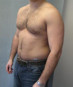 Asymmetric/Unilateral Gynecomastia Surgery