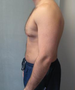 Asymmetric/Unilateral Gynecomastia Surgery