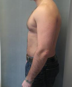 Asymmetric/Unilateral Gynecomastia Surgery