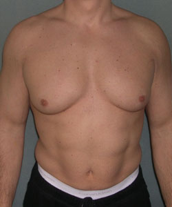Gynecomastia Surgery for Bodybuilders Before Photo Gynecomastia Surgery for Bodybuilders