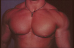 Gynecomastia Surgery for Bodybuilders