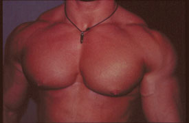 gynecomastia for bodybuilders