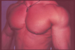 Gynecomastia Surgery for Bodybuilders