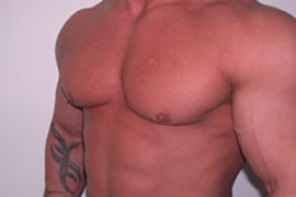 Gynecomastia Surgery for Bodybuilders