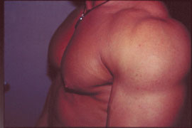 Gynecomastia Surgery for Bodybuilders