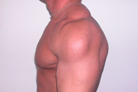 Gynecomastia Surgery for Bodybuilders