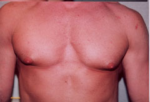 Gynecomastia Surgery for Bodybuilders
