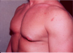 Gynecomastia Surgery for Bodybuilders