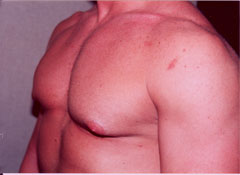 Gynecomastia Surgery for Bodybuilders