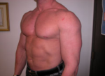 Gynecomastia Surgery for Bodybuilders