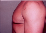 Gynecomastia Surgery for Bodybuilders