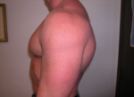 Gynecomastia Surgery for Bodybuilders