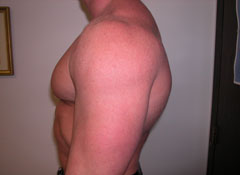 Gynecomastia Surgery for Bodybuilders