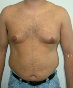 Pseudogynecomastia