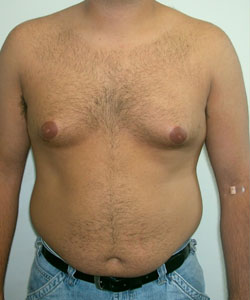 Pseudogynecomastia