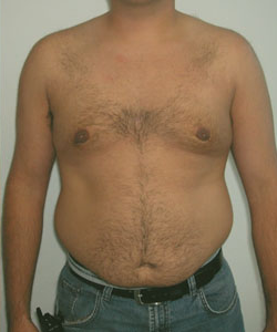 Pseudogynecomastia After Photo Pseudogynecomastia