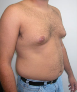 Pseudogynecomastia