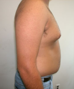 Pseudogynecomastia