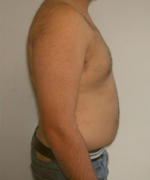 Pseudogynecomastia