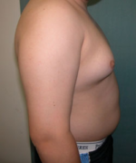 Pseudogynecomastia