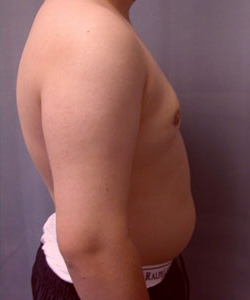 Pseudogynecomastia After Photo Pseudogynecomastia