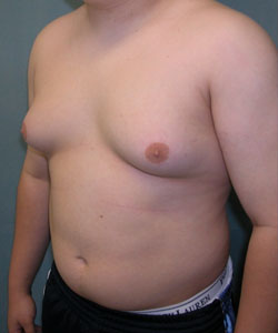 Pseudogynecomastia