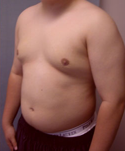 Pseudogynecomastia